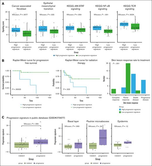 Analysis based on the expression of progression signature among patients with stage I MF. (A) Patients with stage I MF with high-progression signature showed significantly increased CAF (P = .008), epithelial-mesenchymal transition (P = .025), JAK-STAT signaling (P = .059), NF-κB signaling (P < .001), and TCR signaling (P = .003) compared with those with low-progression signature. (B) Patients with stage I MF and a high-progression signature at diagnosis were more likely to progress (log-rank test, P < .001), receive radiation treatment (log-rank test, P = .023), and have a poor treatment response (P < .001) during follow-up than those with a low-progression signature. JAK-STAT, Janus kinase-signal transducer and activator of transcription; KEGG, Kyoto Encyclopedia of Genes and Genomes; TCR, T-cell receptor.