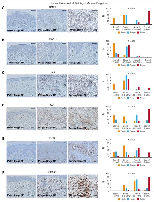 Results of IHC staining in patch-, plaque-, and tumor-stage MF. (A) TIMP1, (B) RAC2, (C) SMA, (D) FAP, (E) DCN, and (F) CD163. IHC staining intensity was rated on a scale of 0 to 3 using a semiquantitative method. The ratings were as follows: 0, 1, 2, and 3, indicating <10%, 10% to 30%, 30% to 50%, and >50%, respectively, of the total area of interest (magnification ×200; scale bar, 200 μm).