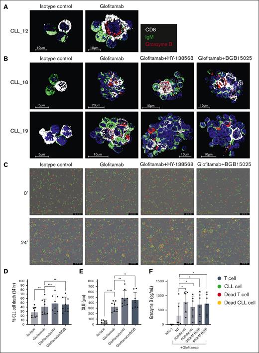 The effect of glofitamab and HPK1 inhibitors on immune synapse formation, granzyme B induction, and CLL cell death. (A-B) CLL cells were seeded on poly-L-lysine coated glass, then treated with 300 nM HY-138568 or with 600 nM BGB15025 for 2 hours. Then the cells were incubated with 1 μg/mL of the CD20XCD3 bispecific antibody glofitamab or human immunoglobulin G (IgG) kappa isotype control for 48 hours. The cells were fixed and permeabilized, followed by staining for CD8 (white), granzyme B (red), immunoglobulin M (IgM) (green), and DAPI (4′,6-diamidino-2-phenylindole) (blue). The images presented are 3D reconstruction of representative confocal imaging of synapse formation between B (green) and CD8+ T (white) CLL cells. Patients are coded by numbers and displayed as CLL_number. (A) Representative images of cells treated with isotype control or glofitamab. (B) Representative images of cells treated with isotype control, glofitamab, glofitamab and HY-138568, or glofitamab and BGB15025 (n = 5). (C-E) B and T cells were isolated from CLL patients–derived PBMCs using B-CLL and pan T isolation kits. Isolated B cells (CLL cells) were labeled with BioTracker 488 Green carboxyfluorescein succinimidyl ester (CFSE) dye. Isolated T cells were treated with 300 nM HY-138568 or with 600 nM BGB15025 for 2 hours. Then, CLL cells and autologous T cells were seeded at 4:1 effector to target ratio and incubated with 1μg/mL of the anti-CD20 × anti-CD3 bispecific antibody glofitamab or isotype control for 24 hours. Cytotox red dye was used to detect cell killing. CLL cell killing (% green + red cells/green cells) was analyzed using Incucyte system for indicated times. At least 4 images from distinct regions within each well were taken at intervals of 6 hours. The experiment was performed in triplicates. (C) Representative images from 2 time points using cells from 1 patient. (D) Quantification of % CLL cell killing using glofitamab (± HPK1 inhibitors) or isotype control after 24 hours of incubation (n = 8). (E) SLD (in micrometers) of clusters after 24 hours of incubation. (F) CLL cells were treated with the indicated concentration of HY-138568 or BGB15025 for 2 hours. Following treatment, the cells were incubated with 1 μg/mL of the anti-CD20 × anti-CD3 bispecific antibody glofitamab or isotype control for 48 hours. Granzyme B levels were measured from supernatants using ELISA-based assay platform (n = 6). ∗P < .05, ∗∗P < .01, ∗∗∗P < .001, ∗∗∗∗P < .0001. HY, HY-138568; NT, no treatment; SLD, sum of longest diameter.