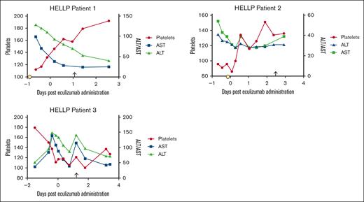 Transaminases and platelet count trends before and after eculizumab administration. Time 0 indicated the time of eculizumab administration. Delivery is noted with an arrow. Corticosteroid administration is represented by the yellow circle. In patient 3, corticosteroids were administered 6 days before eculizumab. The values of platelets (×109/L), AST (units per liter), and ALT (units per liter) are shown. ALT, alanine aminotransferase; AST, aspartate aminotransferase.