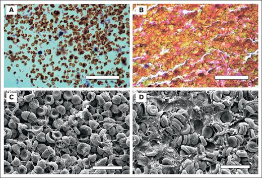 Morphology of the platelet-depleted blood clots right after formation and after unconstrained compaction. Representative light microscopy (A-B) and scanning electron microscopy (C-D) images of clots from platelet-depleted reconstituted blood samples before (A,C) and after (B,D) clot shrinkage over 60 minutes, showing nonaggregated (A,C) and aggregated (B,D) RBCs. Scale bars, 50 μm (A-B) and 15 μm (C-D).