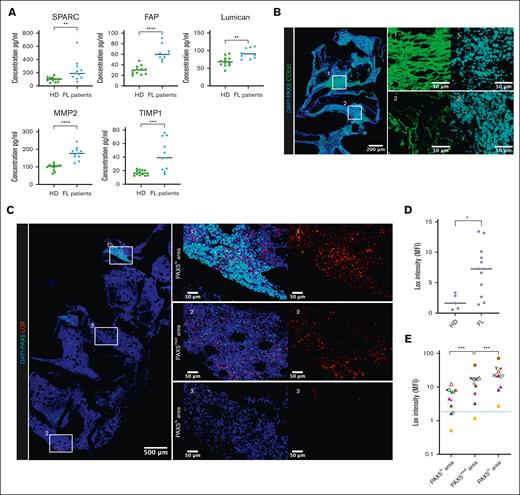 Characterization of the ECM niche in the BM from patients with FL. (A) Soluble matrix protein levels measured in the BM plasma from patients with FL (n = 11) and HDs (n = 12) using Luminex assay. Statistical significance was determined using the Mann-Whitney nonparametric U test. ∗∗P < .01; ∗∗∗P < .001; ∗∗∗∗P < .0001. (B) Immunofluorescence on FL BM sections for PAX5 (cyan) and collagen VI (ColVI; green). Nuclei were counterstained with DAPI (4′,6-diamidino-2-phenylindole). Scale bar, 200 μm. Boxes indicate 2 PAX5hi areas magnified in right panels for ColVI and PAX5 staining (scale bars, 50 μm). (C) Immunofluorescence on FL BM sections for PAX5 (cyan) and LOX (red). Nuclei were counterstained with DAPI. Scale bar, 500 μm. Boxes indicate areas magnified in right panels in which scale bars represent 50 μm. Each box illustrates a category of PAX5 expression area: (1) PAX5hi area, (2) PAX5med area, and (3) PAX5lo area. (D) Quantification of LOX signal intensity in HD (n = 5) vs patients with FL (n = 12). Each dot corresponds to the quantification of the whole slide for 1 sample (HD or FL). Statistical significance was determined using the Mann-Whitney nonparametric U test. ∗P < .05. (E) Quantification of LOX signal intensity in the 3 categories of PAX5 frequency areas in patients with FL (n = 12). Each symbol represents a different patient with FL. The green dotted line represents LOX intensity level in HDs. Statistical significance was determined using the Friedman test with Wilcoxon matched-pairs comparisons. ∗∗∗P < .001. hi, high; lo, low; med, medium; MFI, mean fluorescence intensity.