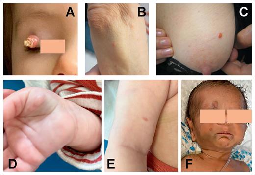 Skin involvement by NTRK1-rearranged histiocytosis. (A) Single lesion on the eyelid of a 2-year-old girl (AP13). (B-C) Skin lesions of a 70-year-old female (AP11). (D-E) Multiple skin lesions of a female newborn (AP27). (F) Multiple skin nodules of a male newborn (AP24).