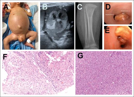Extracutaneous or systemic involvement by NTRK1-rearranged histiocytosis. (A) Liver involvement in a female newborn (AP27). (B-C) Kidney and bone involvement in a male newborn (PK1). (D-E) Large nodule obstructing the right main bronchus in a male infant (AP32). (F-G) Histology of liver and bronchia involvement (hematoxylin and eosin, original magnification ×20).