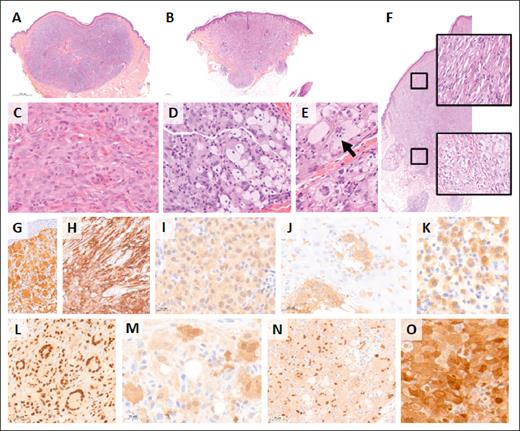 Histology and immunophenotype of NTRK1-rearranged histiocytosis. Low magnification photomicrographs of 2 exemplary skin lesions with either a well-limited pushing nodule in the dermis (A; AP30) or a more infiltrative lesion with finger-like borders (B; AP16). Histiocytes were medium sized with eosinophilic cytoplasm in early type lesions (C; AP11), whereas mature lesions contained larger mononucleated cells with a foamy cytoplasm (D; AP30) and multinucleated Touton giant cells (E; AP17). Some multinucleated cells demonstrated emperipolesis (arrow). Case AP25 was early type in the upper part and mature in the deep dermis (F). (A-F) Hematoxylin and eosin staining. Immunohistochemistry with pan-TRK (G-K) showing strong expression of multinucleated cells (G; AP19) and mononucleated spindle cells (H; AP31) and milder expression in an early type lesion (I; AP32). Positive cells were detectable within the epidermis in a few cases (J; AP12). In this early type lesion, only a fraction of the mononucleated histiocytes expressed pan-TRK (K; AP09). Cells were positive with histiocyte markers, such as PU.1 (L; AP10), and some also expressed S100 (M; AP24). Frequent positivity for cyclin D1 (N; AP30) and phosphorylated extracellular signal-regulated kinase (phophoERK) (O; AP32) confirmed the activation of the MAPK pathway in these neoplasms with NRTK1 fusions.