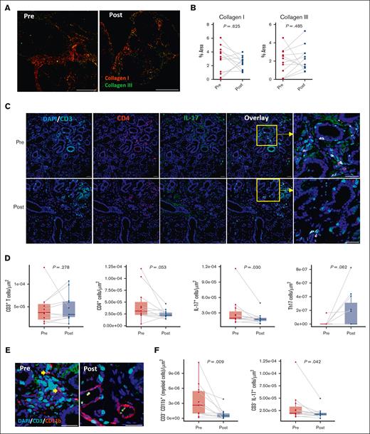 In MSGs, ROCK2 inhibition decreased IL-17 production by non–T cells. (A) Representative PSR staining paired with polarized microscopy of labial MSGs showing collagen type I (red) and collagen type III (green) in biopsies before and after treatment with belumosudil. (B) Percentage area of collagen types I and III in labial MSGs (n = 11; Wilcoxon signed-rank test). (C) Representative multiplex immunofluorescence staining for DAPI (blue), CD3 (cyan), CD4 (red), and IL-17 (green) in labial MSGs before and after treatment with belumosudil with close-up view of marked region in yellow. (D) Changes in CD3+ T, CD4+, IL-17+, and Th17 cells after belumosudil treatment (n = 11; Wilcoxon signed-rank test). (E) Representative multiplex immunofluorescence staining of DAPI (blue), CD3 (cyan), and CD11b (red) in MSGs before and after treatment with belumosudil. (F) Changes in myeloid cells and CD3− IL-17+ non–T cells (n = 11; Wilcoxon signed-rank test). P value < .05 is considered significant. Scale bar of 100 μm was used.