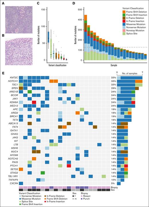 The molecular landscape of prMZL. Histology (hematoxylin and eosin) of a representative case of prMZL. (A) The renal parenchyma is effaced by a vaguely nodular proliferation of small- to medium-sized lymphoid cells with round nuclei, condensed chromatin, and pale cytoplasm. (B) Lymphoepithelial lesions are evident in the urothelium of the renal pelvis. (C) Distribution of somatic mutation burdens in prMZL cases, represented as a box plot across samples. (D) Spectrum of somatic variant classifications in prMZL samples, with frequencies categorized by mutation type, including frameshift deletions, insertions, missense mutations, and nonsense mutations. (E) Oncoplot depicting the mutation profiles of genes frequently altered in prMZL cases. The columns represent individual samples, and rows represent the most commonly mutated genes. The color-coded legend indicates the variant classification, biopsy type, sex, and second differentiation. Percentages on the right indicate the proportion of samples harboring mutations in each gene. f, female; m, male; no., number.
