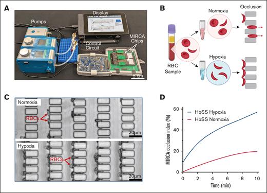 MIRCA device, assay schematic, and readouts. (A) The current MIRCA system setup includes 2 FlowEZ pressure pumps with a Link module for automated pressure control, a control circuit that interfaces with 2 MIRCA chips for signal acquisition and processing, and a 7-inch touchscreen display. (B) Illustration of the MIRCA assay steps, in which isolated RBCs are either incubated in PBS (under NOI) or sodium metabisulfite (MBS) (under HOI) and perfused through a micropillar network in which poorly deformable RBCs occlude. (C) Brightfield images revealing the difference in occlusion levels for a typical HbSS sample under NOI and HOI in the 3 μm array. Arrows illustrate RBCs stuck in the micropillars with more RBCs in HOI compared with NOI. (D) Time course of occlusion indices obtained through the MIRCA device for a typical HbSS sample in NOI and HOI during sample perfusion.