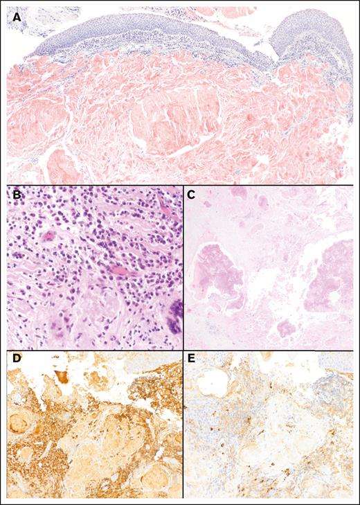 EMP involving the larynx (vestibular fold) with associated light chain amyloid (patient 7). (A) Tumor forming subepithelial amyloid is detectable in the Kongo red staining (om ×25). (B-C) Subepithelial mature plasma cells (B, om ×20) and amyloid depositions (C, om ×200) are present. (D-E) Plasma cells show expression of κ (D, om ×400) and remain negative for λ light chain (E, om ×400).