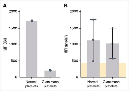 Activation response of GPIIbIIIa-deficient platelets to TTS sera. CD41 expression and platelet activation of Glanzmann platelets in response to sera from patients with TTS. (A) CD41 measured on normal platelets and platelets from a patient with Glanzmann thrombasthenia. (B) Patients’ sera containing or lacking platelet autoantibodies with GPIIb/IIIa specificity were incubated with normal platelets and platelets from a patient with Glanzmann thrombasthenia. Platelet activation was assessed by testing PS exposure after annexin-V staining in flow cytometry, cutoff was defined as mean of negative sera (shown in beige).