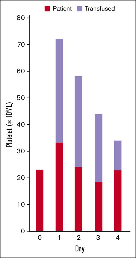 Platelet tracking in a patient who received a single platelet transfusion. The counts of patient’s endogenous (red) and transfused (lavender) platelets on each day before and after the transfusion are presented.