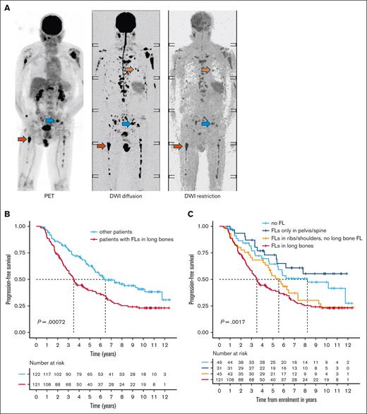 The prognostic role of FL location. (A) Simultaneous PET and DWI scans for a patient newly diagnosed with MM are shown. Examples of FLs in the pelvis, rib, and femur are indicated by blue, orange, and red arrows, respectively. (B) PFS for patients with FLs in the long bones (femur or humerus) detected by DWI or PET at baseline, compared with all other patients. (C) Stratification of the other patients into those without FLs, those with FLs in the pelvis or spine only, and those with FLs in the ribs or shoulders. Group comparisons were performed using the log-rank test.