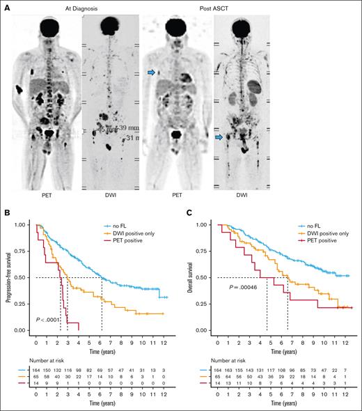 Impact of residual FLs on outcome. (A) Example PET and DWI scans for a patient with MM at baseline and after ASCT. Treatment-resistant (residual) FLs are highlighted with blue arrows. Prognostic significance of residual FLs after ASCT detected by DWI alone or PET on (B) progression-free and (C) overall survival. Group comparisons were performed using the log-rank test.