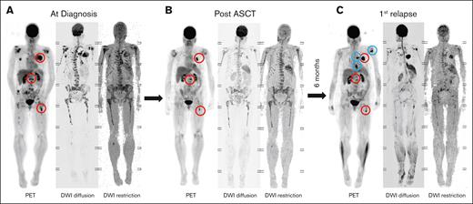 FL persistence and relapse dynamics. (A) Imaging of a patient with multiple FLs at diagnosis. (B) Persistent PET-positive FLs are observed in the same patient after ASCT. (C) Six months after ASCT, the patient experienced a rapid relapse, characterized by regrowth of residual FLs (red circles) and the emergence of new FLs at other sites (blue circles).