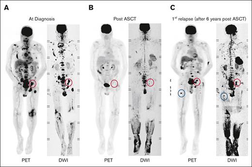 Example of FL dynamics. (A) Imaging of a patient showing FLs at diagnosis. (B) FLs resolved following ASCT. (C) At relapse, 6 years after ASCT, FLs reemerged at their original sites (red circles), and new FLs appeared at other locations (blue circles).