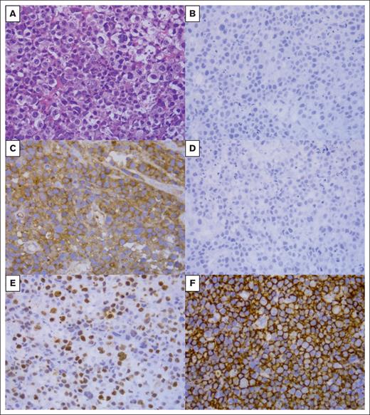 Biopsy of 1 patient with anaplastic plasmacytoma. (A) HE, original magnification ×40. (B) CD20, original magnification ×40. (C) Kappa, original magnification ×40. (D) Lamda, original magnification ×40. (E) Ki67, original magnification ×40. (F) CD138, original magnification ×40. HE, hematoxylin-eosin staining.