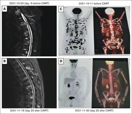 MRI and PET-CT of 1 patient with anaplastic plasmacytoma before and after S103 BCMA CART. (A-B) MRI of 1 patient with anaplastic plasmacytoma before and after BCMA CART. (C-D) PET-CT of 1 patient before and after BCMA CAR T-cell therapy.
