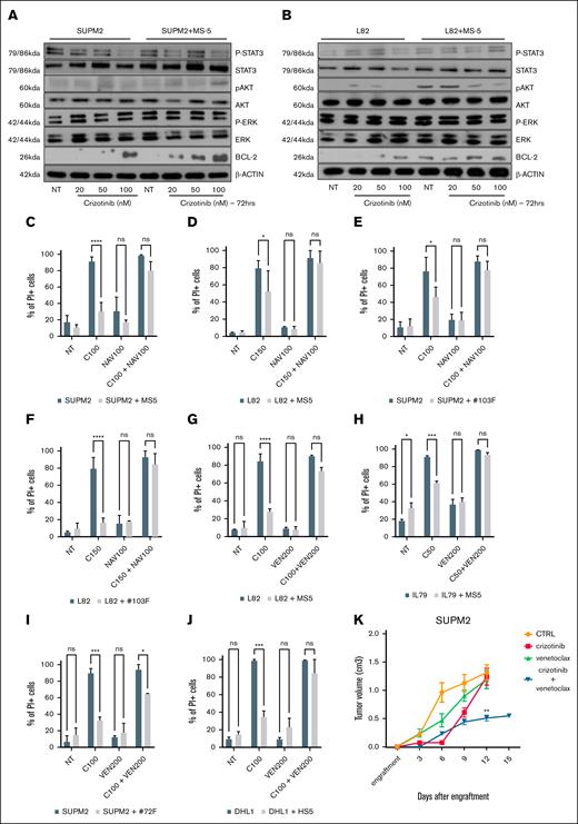 BH3 mimetics overcomes stromal protection to crizotinib in ALK+ ALCL cells. (A) Western blot analysis revealing the relative expression of the indicated (phospho)proteins in SUPM2 cells cultured alone or in the presence of MS-5 and treated with crizotinib (NT, 20-50-100 nM) for 72 hours. (B) Western blot analysis revealing the relative expression of the indicated (phospho)proteins in L82 cells cultured alone or in the presence of MS-5 and treated with crizotinib (NT, 20-50-100 nM) for 72 hours. (C) Bar plot reporting the percent viability assessed by propidium iodide (PI) incorporation in SUPM2 cells cultured alone or in the presence of MS-5 and treated with crizotinib (100 nM) and/or navitoclax (100 nM) for 72 hours. P values were estimated with 2-way ANOVA test using GraphPad software (∗P < .05; ∗∗P < .01; ∗∗∗P < .001; ∗∗∗∗P < .0001). (D) Bar plot reporting the percent viability assessed by PI incorporation in L82 cells cultured alone or in the presence of MS-5 and treated with crizotinib (150 nM) and/or navitoclax (100 nM) for 72 hours. P values were estimated with 2-way ANOVA test using GraphPad software (∗P < .05; ∗∗P < .01; ∗∗∗P < .001; ∗∗∗∗P < .0001). (E) Bar plot reporting the percent viability assessed by PI incorporation in SUPM2 cells cultured alone or in the presence of F103 cells and treated with crizotinib (100 nM) and/or navitoclax (100 nM) for 72 hours. P values were estimated with 2-way ANOVA test using GraphPad software (∗P < .05; ∗∗P < .01; ∗∗∗P < .001; ∗∗∗∗P < .0001). (F) Bar plot reporting the percent viability assessed by PI incorporation in L82 cells cultured alone or in the presence of F103 cells and treated with crizotinib (150 nM) and/or navitoclax (100 nM) for 72 hours. P values were estimated with 2-way ANOVA test using GraphPad software (∗P < .05; ∗∗P < .01; ∗∗∗P < .001; ∗∗∗∗P < .0001). (G) Bar plot reporting the percent viability assessed by PI incorporation in L82 cells cultured alone or in the presence of MS-5 and treated with crizotinib (150 nM) and/or venetoclax (200 nM) for 72 hours. P values were estimated with 2-way ANOVA test using GraphPad software (∗P < .05; ∗∗P < .01; ∗∗∗P < .001; ∗∗∗∗P < .0001). (H) Bar plot reporting the percent viability assessed by PI incorporation in IL-79 PDX-Dline cultured alone or in the presence of MS-5 and treated with crizotinib (50 nM) and/or venetoclax (200 nM) for 72 hours. P values were estimated with 2-way ANOVA test using GraphPad software (∗P < .05; ∗∗P < .01; ∗∗∗P < .001; ∗∗∗∗P < .0001). (I) Bar plot reporting the percent viability assessed by PI incorporation in SUPM2 cells cultured alone or in the presence of F72 and treated with crizotinib (100 nM) and/or venetoclax (200 nM) for 72 hours. P values were estimated with 2-way ANOVA test using GraphPad software (∗P < .05; ∗∗P < .01; ∗∗∗P < .001; ∗∗∗∗P < .0001). (J) Bar plot reporting the percent viability assessed by PI incorporation in DHL1 cells cultured alone or in the presence of HS-5 and treated with crizotinib (100 nM) and/or venetoclax (200 nM) for 72 hours. P values were estimated with 2-way ANOVA test using GraphPad software (∗P < .05; ∗∗P < .01; ∗∗∗P < .001; ∗∗∗∗P < .0001). (K) Antitumoral effect of crizotinib, venetoclax, or combinations in SUPM2 xenografts (6-12 xenografts per group). Error bars represent standard error of the mean (∗P < .05; ∗∗P < .001; ∗∗∗P < .001; ∗∗∗∗P < .0001). CTRL, control; ns, not significant.