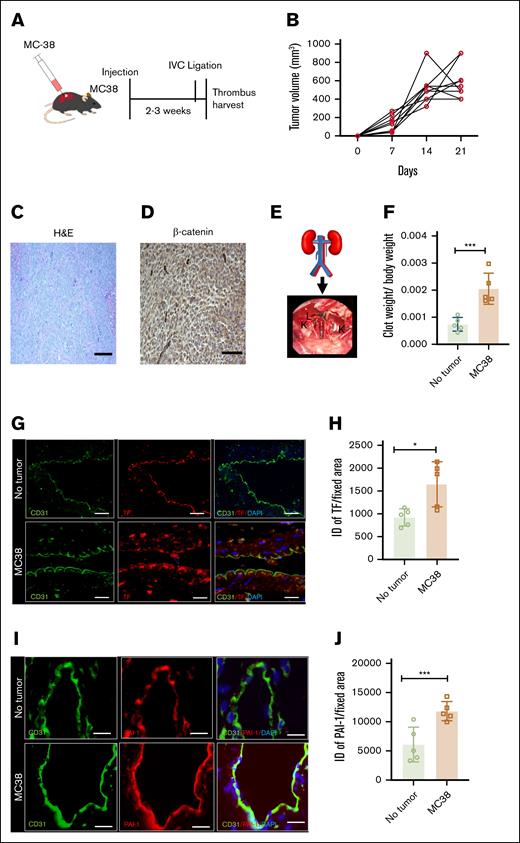 Development of a syngeneic colon cancer tumor model with deep vein thrombosis. (A) A group of 8- to 12-week-old C57BL/6 female mice were injected at the flank with 1 million colon cancer MC38 cells or vehicle. Age-matched mice were compared between the tumor-bearing and control mice. Upon tumors reaching a certain size (typically within 2-3 weeks; see “Methods”), IVC ligation was performed, and clots were harvested 48 hours thereafter. (B) Averages of tumor growth in individual mice injected with MC38 over 3 weeks. (C) Histological analysis of MC38 cells; H&E stain was used. (D) Immunohistochemistry (IHC) of tumors using β-catenin antibody are shown at 100× original magnification (scale bar, 100 μm). (E) A schematic figure of the partial IVC ligation (see “Methods”) and an intraoperative feature of the IVC ligation model. (F) Averages of clot weights normalized to body weight from both groups are shown. Error bars represent the standard error of the mean (SEM; n = 5 mice per group; P = .0016). (G) Paraffin-embedded sections of IVC were stained using anti-TF and anti-CD31 antibodies. Alexa Fluor secondary antibodies and DAPI were used. Images are representative of IVCs from 5 mice in each group. Arrowheads point to endothelial cells. White arrowheads point to the TF expression on endothelial cells, and asterisk points to the subendothelial cells (scale bar, 100 μm). (H) Three images per mouse were analyzed, and a region of interest was marked corresponding to the endothelial cells. ID was normalized to the surface area of the region of interest measured in microns by using ImageJ. Averages of ID normalized to surface area are shown. Error bars represent SEM (P = .0154). (I) IVCs were stained by using anti–PAI-1 and anti-CD31 antibodies. Alexa Fluor secondary antibodies and DAPI were used. Representative images from 5 mice in each group (scale bar, 100 μm). (J) PAI-1 expression was quantified as previously described. Averages of ID normalized to the surface area are shown. Error bars represent SEM (P = .0056). DAPI, 4′,6-diamidino-2-phenylindole; H&E, hematoxylin and eosin; ID, integrated density; K, kidney; L, ligated IVC. ∗P < 0.05, ∗∗P < 0.01, ∗∗∗P < 0.0001, ∗∗∗∗P < 0.0001.