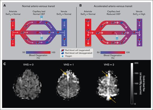 A schematic of the hypothesized physiological mechanism for reduced capillary oxygen offloading secondary to accelerated arteriovenous transit. (A) Under healthy conditions, normal arteriovenous transit allows for sufficient oxygen offloading in the capillaries. (B) Under altered hyperemic conditions such as in chronic anemia, compensatory accelerated CBF may shorten the red cell residency time within the capillaries, due to rapid arteriovenous transit, thus resulting in reduced oxygen offloading and OEF. (C) Representative examples of a participant from each VHS on ASL perfusion-weighted imaging. For VHS of 0, no hyperintensity is observed in the superior sagittal sinus nor straight sinus. For VHS of 1, a region of focal hyperintensity (orange arrow) is observed in the superior sagittal sinus but does not persist spatially to the level of the torcula. For VHS of 2, diffuse hyperintensity (orange arrows) is observed along the superior sagittal sinus across multiple axial slices and extends to the torcula. SaO2, arterial oxygen saturation; SvO2, venous oxygen saturation.