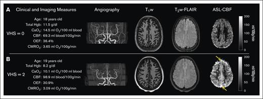 Case examples. Demographic, clinical, and imaging measures are presented alongside angiography, T1-weighted, T2-FLAIR, and CBF images for 2 age-matched individuals with SCD and (A) VHS of 0 and (B) VHS of 2 on ASL MRI. The individual with VHS of 2 (B) had lower total Hb and arterial blood oxygen content; and displayed elevated CBF, reduced OEF, and reduced CMRO2 compared with the individual with VHS of 0 (A). Orange arrows on panel B indicate evidence of signal hyperintensity in the superior sagittal sinus on ASL MRI.