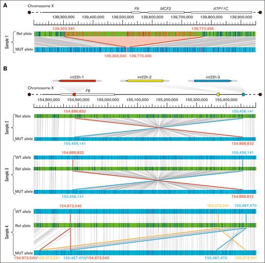 OGM reveals SVs that cause hemophilia at high resolution. For hg38, axes were plotted, indicating the positions of the genes affected by the variants. For each sample, the green bars show the reference sequence chromosome X mapping, and the blue bars show the mapping assembled from the sample's OGM data. Vertical lines on the bars represent the positions of the labels between the hg38 and study sample maps, which are connected by gray lines. The nucleotides listed are not necessarily those of the actual breakpoints but rather indicate the extent of the fragments, as determined by the positions of the labeled DNA motifs within the variant regions and closest to the chromosomal breakpoints. (A) In a sample from patient 1, a deletion region of up to 451 kb was found in Xq27.1. The extent of the deletion is indicated by a red background. The variant caused a complete deletion of F9, MCF2, and one-fifth of ATP11C. (B) Variants in samples from patients 2, 3, and 4 are int22h-related rearrangements. Int22 consists of 3 sets of highly homologous sequences, with int22h-1 located within F8 (indicated by red squares), int22h-2 (indicated by yellow squares), and int22h-3 (indicated by blue squares) located outside the F8 gene. A 567 kb inversion was detected in the Xq28 region in patients 2 and 3, consistent with Inv22 Type I, and patient 3 was an Inv22 carrier. A 94 kb fragment was found in Xq28 of patient 4, which was inverted and repeatedly inserted within F8. MUT, mutated; Ref, reference; WT, wild-type.