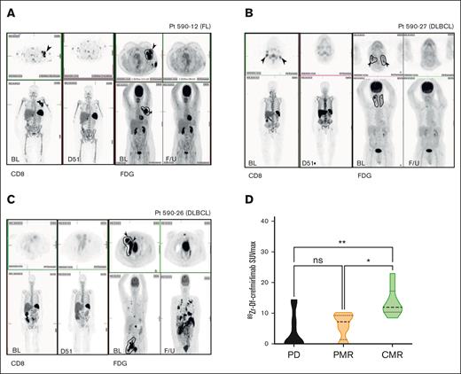 Baseline 89Zr-Df-crefmirlimab (CD8 T-cell) uptake correlates with posttreatment tumor FDG-PET-CT response. (A-C) Representative baseline (BL) CD8 T-cell and paired FDG-PET imaging (and F/U scans ∼D50). (A) A 50-year-old female patient with stage II FL (at diagnosis): whole-body 89Zr-Df-crefmirlimab scan 24 hours postinjection (p.i.) (left) at BL and day 51 on treatment with paired FDG-PET (right). Axial slices of left axillary mass demonstrate intense uptake at BL and CMR on treatment. RT fields are illustrated on the FDG-PET image. (B) A 86-year-old male with DLBCL: whole-body 89Zr-Df-crefmirlimab scan 24 hours p.i. (left) at BL and F/U on treatment with paired FDG-PET (right). Axial slice of bilateral neck lesions demonstrate intense uptake at BL and CMR on treatment. RT fields are illustrated on the FDG-PET image. (C) A 76-year-old female with DLBCL: whole-body 89Zr-Df-crefmirlimab scan 24 hours p.i. (left) at BL and F/U on treatment with paired FDG-PET (right). On BL scans, axial slices of right external iliac mass demonstrate intense uptake of FDG pretreatment, but no BL 89Zr-Df-crefmirlimab uptake in tumor sites; however, some marrow uptake plus excretion of catabolized 89Zr in bowel is seen. Although the patient had a CMR in RT-treated volume, they had extensive PD out-of-treated volume on treatment. Radiotherapy fields are illustrated on the FDG-PET image. (D) Tumor uptake (SUVmax) of 89Zr-Df-crefmirlimab 24 hours p.i. at baseline was significantly higher in patients who achieved a CMR on study (P = .003; adjusted P values ∗P = .01, ∗∗P = .002). D51, 51 days after treatment commencement; ns, not significant; PD, progressive disease; PMR, partial metabolic response.