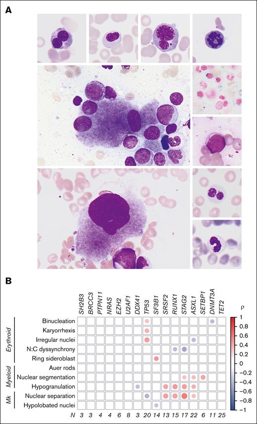 Genetic morphologic associations in MDS. (A) Dysplastic features evaluated include (clockwise from top left) erythroid binucleation, erythroid nuclear irregularity, erythroid karyorrhexis, erythroid mitosis, ring sideroblast, Auer rod, abnormal myeloid nuclear segmentation, myeloid hypogranulation, hypolobated megakaryocyte, and separated megakaryocyte nuclei. (B) Correlation matrix showing association between evaluated dysplastic features and gene mutations in the discovery cohort. Only associations with adjusted P value < .05 are shown. The area of each circle represents the absolute Spearman correlation coefficient (ρ). Mk, megakaryocytes; N, number of samples; N:C, nuclear-to-cytoplasmic.