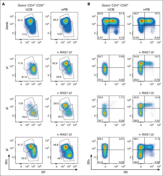 RAG1-SCID HSPCs progress to the DP stage, but with a different immunophenotype than those differentiated from healthy control or RAG1-corrected HSPCs. Flow cytometry of week 8 ATOs. CD7×CD1a (A) and CD3×CD1a (B) flow cytometry plots of CD4/CD8 DP controls and patient cells without and with RAG1 (+LV) correction.