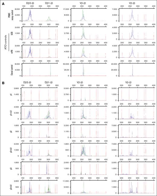 In vitro differentiated T cells from healthy control and MND-c.o.RAG1-rescued RAG1-SCID patient HSPCs show comparable TRB diversity to healthy PBMCs. GeneScan visualization of Dβ-Jβ (left column) and Vβ-Jβ (middle and right columns) TCR gene rearrangements using DNA from week 8 ATOs. Primers covering Dβ1, Dβ2, Jβ1.1-1.6 and Jβ2.1-2.6 and all 23 Vβ families were included. The Jβ1 cluster (Jβ1.1-6) is shown in green, the Jβ2 cluster (Jβ2.1-7) in blue. For the Vβ-Jβ rearrangements, the 13 Jβ primers were divided over 2 reactions: the middle column includes the first 9, Jβ1.1-1.6 and Jβ2.2, 2.6, 2.7 and the right column includes the remaining 4 (Jβ2.1, 2.3-2.5). (A) TRB rearrangements in healthy control PBMCs (used as polyclonal assay control), ATOs with differentiated mPB and UCB CD34+ HSPCs and a clonal assay control (cell line40) for comparison. (B) ATOs with differentiated patients’ CD34+ HSPCs, corrected (+LV) and noncorrected.