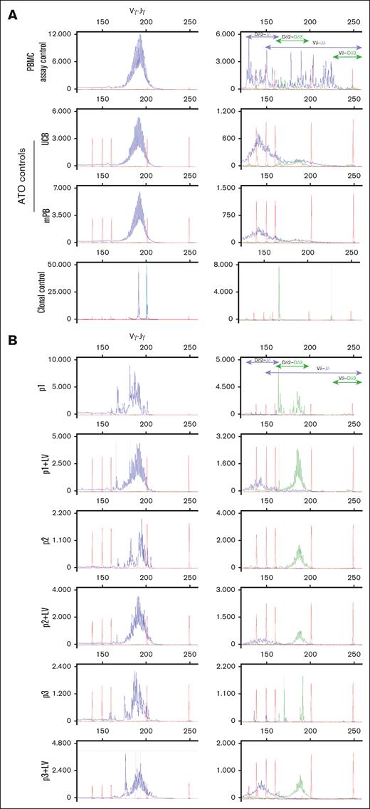 In vitro differentiated γδ T cells from MND-c.o.RAG1-rescued RAG1-SCID patient HSPCs have more immature TRD D-D rearrangements remaining compared to healthy controls. GeneScan visualization of all Vγ-Jγ rearrangements of the TRG (left column). Right column shows different Dδ2-Jδ, Dδ2-Dδ3, Vδ-Jδ and Vδ-Dδ3 rearrangements of TRD. Jδ is labeled blue and Dδ3 is green. (A) TRG and TRD rearrangements in healthy control PBMCs (used as polyclonal assay control), ATOs differentiated from mPB and UCB CD34+ HSPCs and a clonal assay control (cell line40) for comparison. (B) ATOs with differentiated patients’ CD34+ HSPCs, corrected (+LV) and noncorrected.