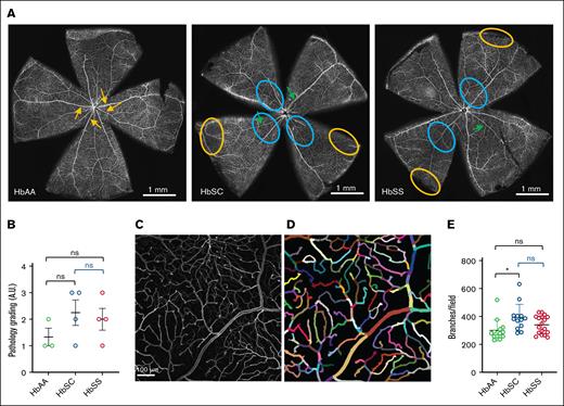 Retinal vascular alterations in HbSC and HbSS mice. (A) Representative whole mount fluorescence images of retinas from 12-month-old HbAA, HbSC, and HbSS mice. HbAA retina (left) showing normal vasculature with well-defined major vessels radiating from the central optic nerve head (orange arrows), uniform branching, and no significant dropout. HbSC and HbSS retinas (middle and right) show reduced numbers of major vessels with irregular thickness (green arrows), peripheral vascular dropout (orange circles), and central-retinal/midretinal vascular dropout (blue circles). Scale bars, 1 mm. (B) Pathological grading on retinal vascular alterations in 12-month-old HbAA, HbSC, and HbSS mice based on vessel morphology, density, and the presence of avascular regions. (C-D) Representative confocal image (C) and reconstructed image generated with an automated pipeline (D) for quantification of retinal vascular branching (scale bar, 100 μm). (E) Quantification of vascular branching in HbAA, HbSC, and HbSS mice (HbAA, n = 4; HbSC, n = 4; HbSS, n = 4). Comparisons to HbAA mice are indicated in black; comparisons between HbSC and HbSS mice are indicated in blue. ∗P < .05. ns, no significant difference.