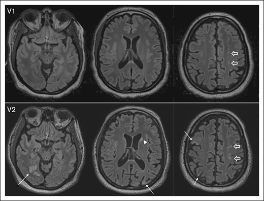 Representative images depicting progression of SCI burden between V1 and visit 2 V2, with brain MRI completed 12 months apart. At V1, axial fluid-attenuated inversion recovery (FLAIR) images show several punctate foci of hyperintensity in the centrum semiovale (block arrows). At V2, there is interval development of multifocal chronic cortical infarcts; for example, in the right occipital, right and left parietal lobes, and right middle frontal gyrus (arrows), as well as an ischemic focus in the left caudate head (arrowhead). In addition, multifocal FLAIR hyperintense white matter lesions in the centrum semiovale bilaterally have increased in number and conspicuity (block arrows). V1, visit 1; V2, visit 2.
