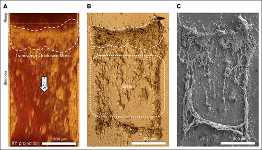 Blood flow was impeded by a mass adopting the structure of a thick transverse cable. (A) Light microscopy showed the formation of a large transverse occlusive mass that spanned the entire cross-section (640 μm). Blood flow direction is indicated by the “flow” arrow. This mass was the most flow-resisting part of the thrombus. (B) Light microscopy of air-exposed thrombus showed islets attached to the glass slide downstream to the cable, previously obscured by blood. ∗A crosscurrent mass downstream to the islets, likely obscured by blood, could only be observed after glass slide removal. (C) Low-magnification SEM of thrombi revealed that the occlusive mass adopted the structure of a thick transverse cable unseen with light microscopy.