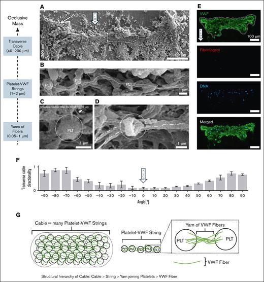 The structural hierarchy of the occlusive mass consisted of a 200-μm-thick transverse cable made of parallel strings of PLTs linked by 1 to 0.05-μm-thin yarns made up of VWF. (A) Intermediate-magnification SEM showed that the transverse cable spanning the width of the stenosis was concave in shape. The thickness of the cable varied across the channel (40-200 μm). (B) High-magnification SEM (dashed square in panel A) revealed beads linked with one another like strings on beads (dashed line). These beads were identified as PLTs based on their diameter (1-2 μm) and appearance. The strings were parallel to each other and oriented perpendicular to the flow, similar to the cable. (C) A PLT linked by fibers. The thinnest fiber detected by SEM had a diameter of 0.05 μm. (D) A PLT linked by thicker yarns (0.5-1 μm). This PLT appeared to be degranulated, indicating that the yarns of VWF may have come from PLT α-granules. (E) Confocal microscopy 40-μm-high z-slice of a separate and representative (n = 3) high-shear thrombus labeled for VWF (green), fibrin (red), and DNA (blue). The transverse cable was rich in VWF and lacked fibrin, illustrating that the strings of PLTs were linked by yarns of VWF. (F) Directionality analysis of the transverse cable confirmed the transverse orientation of the PLT-VWF strings. (G) Schematic of the structural hierarchy of the occlusive transverse cable as being composed of strings of PLTs joined by yarns of VWF fibers. PLT, platelet.