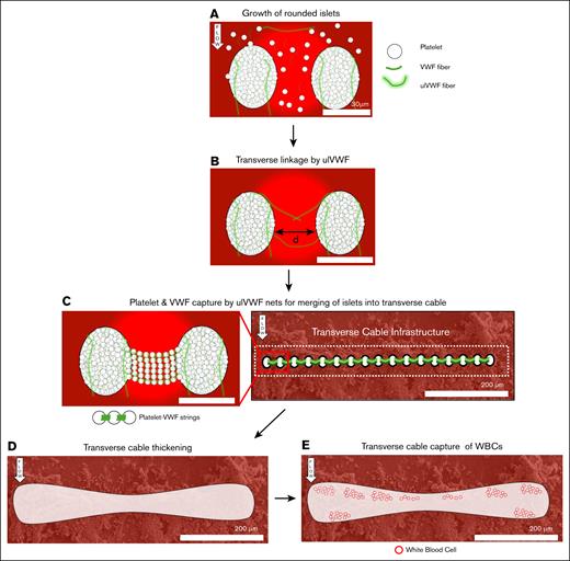 Proposed mechanism for the growth of the strong occlusive transverse cable. (A) Flowing aggregates of platelets and soluble VWF are captured on the collagen-coated glass slide forming rounded islets. ulVWF released by shear-activated platelets enhance growth of islets by catching more platelets. (B) Close islets are then linked by multiple, joined VWF fibers or ulVWF. We expect the maximum distance between 2 islets to be less than twice the length of ulVWFs (distance < 30 μm). (C) The transverse linkage between 2 islets forms a net that traps incoming platelets and VWF, aligning them with the linkage to form platelet-VWF strings. Islets located at the entrance of the stenosis merge transversally with one another and form the transverse cable infrastructure. (D) The transverse cable thickens likely by streamwise growth and streamwise merging. (E) The thicker transverse cable then physically arrests incoming WBCs.