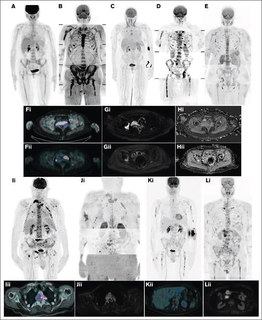 Disease patterns by 18F-FDG–PET/CT and WB-DW-MRI. (A) DD by 18F-FDG–PET/CT; (B) DD by WB-DW-MRI; (C) focal on DD by 18F-FDG–PET/CT; (D) focal on DD by WB-DW-MRI; (E) micronodular disease by WB-DW-MRI; (F) focal disease by 18F-FDG–PET/CT before (i) and after (ii) treatment; (G-H) focal disease by WB-DW-MRI before (i) and after (ii) treatment; (I) PSD by 18F-FDG–PET/CT (coronal, i; axial, ii); (J) PSD by WB-DW-MRI (coronal, i; axial, ii); (K) EMD by 18F-FDG–PET/CT (coronal, i; axial, ii); and (L) EMD by WB-DW-MRI (coronal, i; axial, ii).