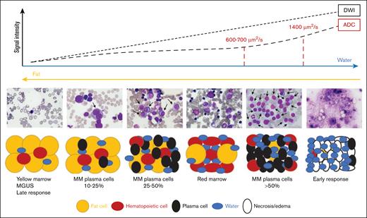Relation between ADC values, signal intensity in DWI sequences, and BM cellular density during disease course and response to therapy. MGUS, monoclonal gammopathy of undetermined significance. Adapted from Dutoit et al92 and Ormond et al.93