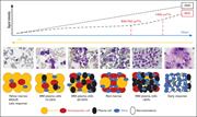 Relation between ADC values, signal intensity in DWI sequences, and BM cellular density during disease course and response to therapy. MGUS, monoclonal gammopathy of undetermined significance. Adapted from Dutoit et al92 and Ormond et al.93