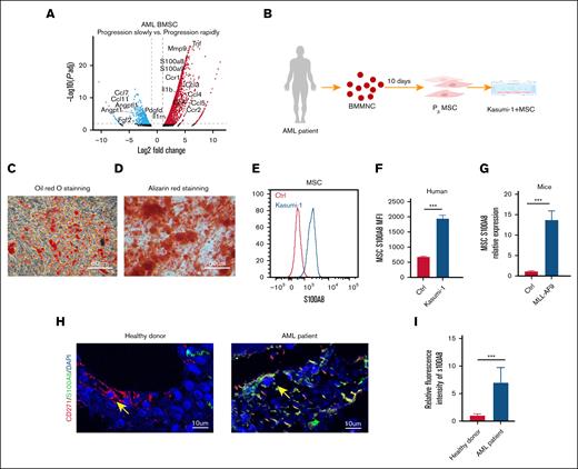 Expression of MSC-derived S100A8 under leukemic state. (A) Transcriptome sequencing data compare the expression of cytokines in MSC-derived AML mice with rapid vs slow disease progression. (B) Flowchart of coculture of patient-derived BM MSC with leukemic cells Kasumi-1. (C) Identify the adipose differentiation capacity of MSC by Oil Red O staining. (D) Identifying the osteogenic differentiation capacity of MSC by Alizarin red staining. (E) Flow plots of representative fluorescence intensity of S100A8 in MSC coculture with Kasumi-1 and control MSC. (F) Mean fluorescence intensity (MFI) of S100A8 in MSCs after coculture with Kasumi-1 cells (n = 3). (G) Expression of S100A8 in BM MSCs from MLL-AF9 mice and normal mice (n = 5). (H-I) Representative immunofluorescence images of human BM sections from a healthy donor and a patient with AML stained for CD271 (red), S100A8 (green), and DAPI (4′,6-diamidino-2-phenylindole; blue), along with quantitative analysis of S100A8 expression based on confocal microscopy (scale bars, 10 μm; n = 6). ∗∗∗P < .001. Ctrl, control; MNC, mononuclear cells.