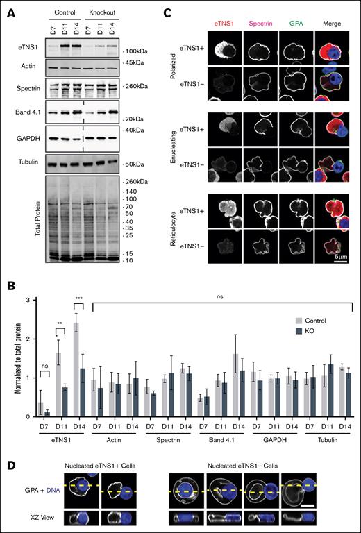 CRISPR-Cas9 KO of eTNS1 in human erythroblasts does not affect assembly of the membrane skeleton or expression of cytoskeletal proteins. (A) Representative western blots of eTNS1, actin, α1,β1-spectrin, protein 4.1R, GAPDH, α-tubulin, and total protein from nontransfected control and eTNS1-KO erythroid cultures; 15 μg protein loaded per lane (dashed lines indicate blots in which lanes were cropped out). (B) Quantification of immunoblots normalized to total protein. Values are mean ± SD from 4 nontransfected controls and 4 KO cultures. ∗∗P < .01; ∗∗∗P < .001. (C) Single optical sections of Airyscan Z-stacks of human erythroblasts from day-14 eTNS1-KO cultures, depicting stages of enucleation, stained for eTNS1 (red), β1-spectrin (magenta), GPA (green), and nuclei (Hoechst; blue). Scale bar, 5 μm. (D) Single XY optical sections (top panels) of Airyscan Z-stacks of polarized and enucleating eTNS1+ and eTNS1− cells were used to construct XZ side views (bottom panels) of each cell at the location of the yellow dashed line in the top panel. (GPA, white; nucleus, blue). eTNS1− cell shapes appeared to resemble biconcave-like discs, with a rim and dimple in some cases), despite the retention of the nucleus in the cell. Scale bar, 5 μm. GAPDH, glyceraldehyde-3-phosphate dehydrogenase; ns, non-significant.