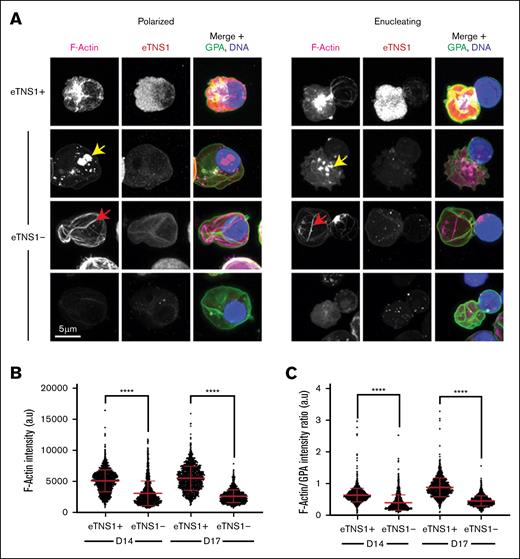 eTNS1 is required to assemble F-actin into the enucleosome during enucleation of human erythroblasts. (A) Maximum intensity projections of Airyscan Z-stacks of polarized and enucleating human erythroblasts from day-14 cultures stained for F-actin (phalloidin; magenta), eTNS1 (red), GPA (green), and nuclei (Hoechst; blue). F-actin in eTNS1− cells assembled into mislocalized foci (yellow arrow), cables (red arrow), or was absent. Scale bar, 5 μm. (B) Quantification of F-actin intensity in eTNS1− and eTNS1+ erythroblasts from eTNS1-KO cultures at days 14 and 17 using the Zeiss CD7. (C) Quantification of F-actin intensity normalized to GPA intensity of eTNS1+ and eTNS1− erythroblasts from eTNS1-KO cultures at days 14 and 17. (B-C) Plots reflect the mean ± SD of 1500 eTNS1+ and eTNS1− erythroblasts from 3 independent eTNS1 CRISPR KO experiments. ∗∗∗∗P < .0001. a.u., arbitrary units.