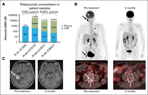 Pola partially penetrates the BBB and pola-based treatment induces complete remissions in CNS lymphoma patients. (A) Bar graph demonstrating the concentration of pola (as measured by acMMAE) in Pt-derived CSF and plasma samples. Plasma and CSF acMMAE concentrations are listed within the green and blue stacked bars, respectively. The relative proportion of pola in the CSF compared to the plasma is listed as a percentage at the top of the stacked bars for patients with synchronous CSF and plasma collections. Pts with CNS lymphoma and systemic DLBCL are separately designated. (B) Serial positron emission tomography scan images from Pt 1 with CNS lymphoma before (left panels) and 2 months after (right panels) pola and intrathecal chemotherapy treatment. Black and white arrows indicate areas of active systemic and CNS disease before treatment, respectively. Top panels demonstrate global assessment of disease status before and after pola as assessed by maximum intensity projection, and the bottom panels show a representative hypermetabolic spinal cord tumor lesion before and after pola treatment. (C) Serial brain magnetic resonance imaging scans from Pt 2 with CNS lymphoma before (left panel) and 5 months after (right panel) treatment with pola and ibrutinib. Imaging shows a complete response to treatment with resolution of the large contrast-enhancing CNS lesion (arrow) on T1-weighted postgadolinium contrast axial images. CxDx, cycle and day of pola treatment; N/A, not applicable; Pt, patient.