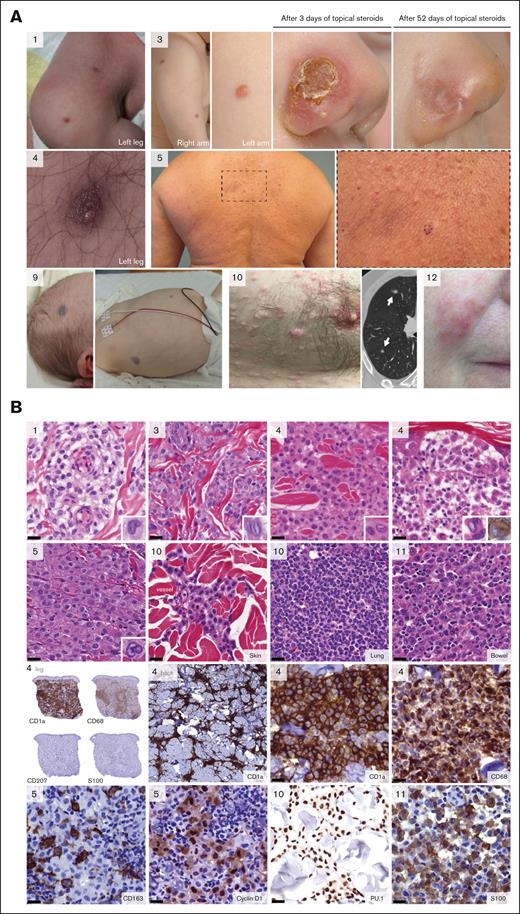 Clinical and pathologic features of IDCH. (A) Photographs of lesions in cases 1, 3, 4, 5, 9, 10, and 12. Shown are congenital purpuric papules in case 1, which spontaneously regressed over several weeks.6 Case 3 was a 9-month-old child with multiple yellow-brown papules spread over the body and an erythematous, crusted nodule on the right nasal ala. The lesion on the nose was successfully treated with topical steroids, whereas the other lesions regressed spontaneously over several months. Cases 4 and 5 were adults with multiple brown-red or skin-colored, asymptomatic papules on the trunk and extremities, which responded to ultraviolet B phototherapy. Case 9 was an infant with congenital purpuric skin lesions who developed anemia, thrombocytopenia, and splenomegaly in the first month after birth, reminiscent of infants developing high-risk LCH. The child achieved complete remission with vinblastine/prednisone chemotherapy. In contrast, cases 10 and 12, both adults, died from progressive disease despite systemic treatment. Case 10 presented with >100 papules spread over the body and bilateral lung nodules (indicated by white arrows). Case 12 presented with skin lesions on the right cheek but later developed locally invasive disease requiring facial surgery and bilateral breast lesions (not shown). (B) Photomicrographs of tissue slides stained with hematoxylin and eosin (H&E) or stained for specific proteins; the latter are indicated at the bottom of the images. Case numbers are provided in the upper left corners; black bars in the lower left corners indicate 20 μm. Shown are infiltrates of histiocytoid cells with frequent nuclear grooves or indentations, as highlighted in several inlets. Clusters of cells were often located around vessels, as illustrated by H&E images of cases 1 and 10. In case 4, a small intraepithelial focus of abnormal histiocytes was observed in the lesion of the back (right H&E image); this lesion was also notable for more cellular atypia and CD163+ multinucleated cells (inlet). Dense infiltrations of similar, histiocytoid cells were observed in extracutaneous lesions, often accompanied by prominent lymphocytic infiltrates (not shown). As illustrated by multiple photomicrographs of case 4 (with an ETV3::NCOA2 fusion), lesional cells stained positive for CD1a and CD68, and were negative for CD207/Langerin and S100. Yet, CD68 was negative and S100 was positive in other cases (supplemental Table 2). The pattern of CD68 expression was diffuse granular cytoplasmic expression, with occasional Golgi dot-like accentuation (most notable in cases 1 and 7). The pattern of S100 expression was diffuse cytoplasmic and nuclear expression, although nuclear expression was less apparent in case 11 (shown). As illustrated by the photomicrograph of the back lesion of case 4, CD1a staining sometimes revealed a remarkable branching pattern in the deeper dermis, in which histiocytes were often located around vessels and, from there, spread through the dermal collagen. CD163 was generally negative, with rare positive lesional cells, whereas cyclin D1 frequently stained the lesional cells, and PU.1 was diffusely positive. Mutational status of all patients is depicted in Figure 2A. Detailed clinical and pathologic information is provided in supplemental Tables 1 and 2.