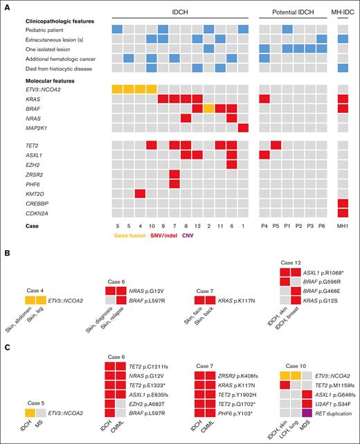 Molecular characterization of IDCH and additional myeloid malignancies. (A) Oncoprint depicting clinicopathologic and molecular features of 12 patients with IDCH, 6 patients with potential IDCH, and 1 patient with MH-IDC (depicted on the far right). Every column represents 1 patient; case numbers are provided at the bottom of the plot. Blue squares indicate the presence of a clinicopathologic characteristic, orange squares indicate the presence of a gene fusion, red squares indicate the presence of a SNV or insertion and/or deletion (indel), and purple squares indicate the presence of CNV. (B) Genetic findings in 4 patients of whom 2 separate IDCH lesions were molecularly analyzed, demonstrating identical mutations in paired lesions in all cases. In addition, mutations unique to 1 lesion were sometimes identified. (C) Genetic findings in 4 patients of whom the additional myeloid malignancy was molecularly analyzed. Shared genetic alterations between the IDCH and additional hematologic malignancy were identified in 2 of 4 cases, strongly suggesting a clonal relationship of these hematopoietic neoplasms. Details on detected genetic alterations, including variant allele frequencies, are provided in supplemental Tables 3 and 4. CNV, copy number variation; MH-IDC, malignant histiocytosis with an indeterminate dendritic cell phenotype; SNV, single-nucleotide variant.