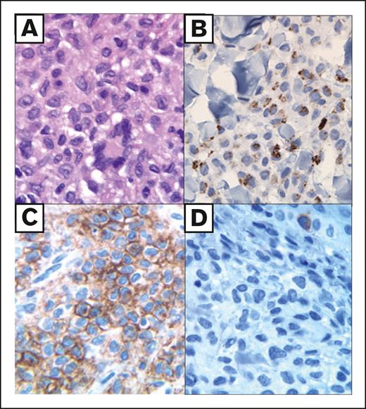 Histologic features of IDCH. Adult skin lesion (multifocal) with a dermal histiocytic infiltrate composed of cytoplasmic rich cells with (A) minimal nuclear folds and occasional Touton-like giant cells (hematoxylin and eosin), (B) an indeterminate cell immunophenotype including paranuclear cytoplasmic dot-like CD68 staining (CD68 PGM1 clone), (C) diffuse membranous CD1a (CD1a), and (D) negative Langerin/CD207 (CD207). The lesional infiltrate was negative for CD163 and Factor XIIIa but diffusely positive for S100 and fascin (not shown).