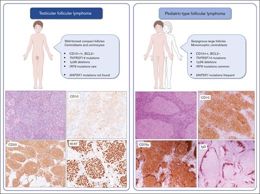 Comparison of 2 distinct variants of t(14;18)-negative follicular lymphoma (FL) common in the pediatric age group: T-FL and PTFL. They differ in histological, immunophenotypic, and genetic features. (H&E, upper left hand corners, original magnification, x100; CD10, CD20, CD79a, and IgD, original magnification, x200; Ki-67, x400) IgD, immunoglobulin D. Figure created, in part, with BioRender.com.