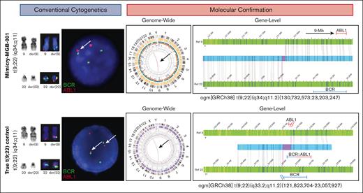 CBA and molecular evaluation of chromosomal mimicry in MGB-Mimicry-001 findings. Conventional cytogenetic studies (karyotyping and FISH) are shown on the left. Molecular confirmation with OGM is shown on the right. In the top panel, CBA and FISH studies detect a t(9;22)(q34;q11.2) with BCR::ABL1 fusion by FISH. OGM notes rearrangements on chromosomes 9 and 22 that do not overlap with BCR or ABL1. In the bottom panel, CBA, FISH, and OGM is showing a positive control with a confirmed t(9;22), leading to BCR::ABL1.