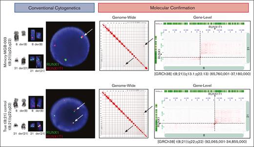 CBA and molecular evaluation of chromosomal mimicry in MGB-Mimicry-003 findings. Conventional cytogenetic studies (karyotyping and FISH) are shown on the left. Molecular confirmation with Hi-C is shown on the right. In the top panel, CBA and FISH studies detect a t(8;21)(q22;q22) with RUNX1::RUNX1 fusion by FISH. Hi-C notes rearrangements on chromosomes 8 and 21 that do not overlap with RUNX1 or RUNX1T1. In the bottom panel, CBA, FISH, and OGM is showing a positive control with a confirmed t(8;21) leading to RUNX1::RUNX1T1.