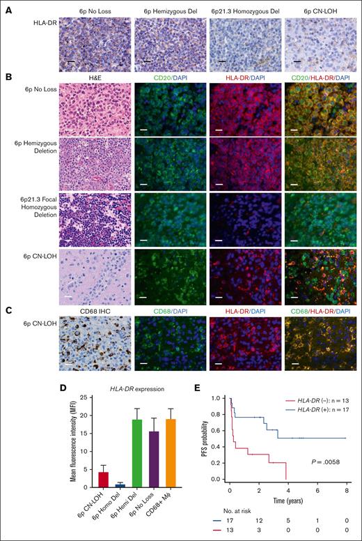 Correlation of HLA-DR expression with chromosome 6p CNA status in PCNSL. (A) Expression of HLA-DR in PCNSL was demonstrated by immunohistochemistry (IHC) in different genomic groups of 6p. Tumors with no loss at 6p or with hemizygous (1 copy) deletion at 6p21.3 exhibited stronger expression of HLA-DR than tumors with HD at 6p21.3 or CN-LOH at 6p. Original magnification, ×400. Scale bar, 20 μm. Hematoxylin and eosin (H&E) counterstain. (B) Expression of HLA-DR in PCNSL was demonstrated by in situ hybridization and colocalization with CD20 and CD68. Multiplex fluorescence in situ hybridization probes were used to colocalize coexpression of HLA-DR (red) with CD20 (green) in 30 diagnostic FFPE specimens. Original magnification, ×400. Scale bar, 20 μm. DAPI (4’,6-diamidino-2-phenylindole; blue) counterstain was used to localize nuclei. Additional example images are provided in supplemental Figure 9. (C) 6p CN-LOH with colocalization of HLA-DR (red) and the macrophage (MΦ) marker CD68 (green). CD68 IHC was used to localize tumor macrophages. (D) HLA-DR expression by mean fluorescence intensity (MFI) in different 6p CNA subgroups and infiltrating macrophages (CD68+) as a positive internal control. Negative HLA-DR coexpression by CD20+ lymphoma cells, defined as MFI 2 standard deviations below the mean MFI of HLA-DR expressed by tumor-associated macrophages (n = 5 cases), was detected in each of the 2 6p21.3 focal HD cases and in 9 of the 10 6p CN-LOH cases tested. Pairwise comparisons showed that the MFI of HLA-DR expression by lymphoma was significantly lower in PCNSL with 6p CN-LOH (n = 10) and 6p21.3 focal HD (n = 2) than with 6p hemizygous deletion (n = 9, P = .0007 and P = .00022, respectively), to 6p no loss (n = 9, P = .013 and P = .0029, respectively), and to CD68+ macrophages (P = .0022 and P = .0024, respectively). There was no significant difference in the MFI of HLA-DR expression by lymphoma cells among tumors with 6p hemizygous deletion, 6p no loss, and infiltrating macrophages, nor between 6p CN-LOH and 6p focal HD. P values are calculated from 2-sided t test. (E) Kaplan-Meier analysis demonstrates that PCNSL cases with negative tumor expression of HLA-DR exhibited shorter PFS than HLA-DR–positive PCNSL (P = .0058 by 2-sided log-rank test). Absent HLA-DR expression by lymphoma was associated with a trend toward shorter OS (data not shown).
